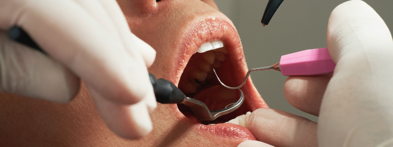 dental operation of a mouth with tooth decay